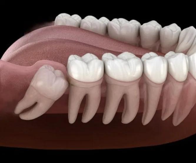 Perché i denti anteriori si spostano con il tempo? Sfatiamo un mito