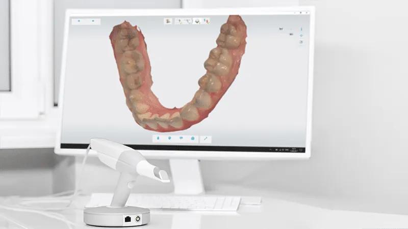 Scansione digitale 3D: perché è migliore delle impronte tradizionali