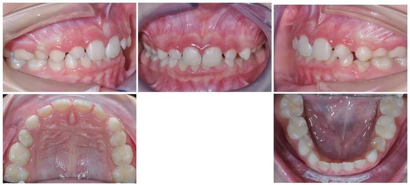 Morso inverso — dopo il trattamento