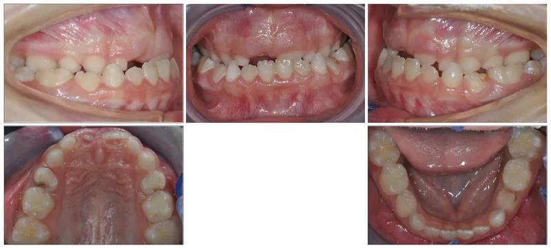 Morso inverso — prima del trattamento