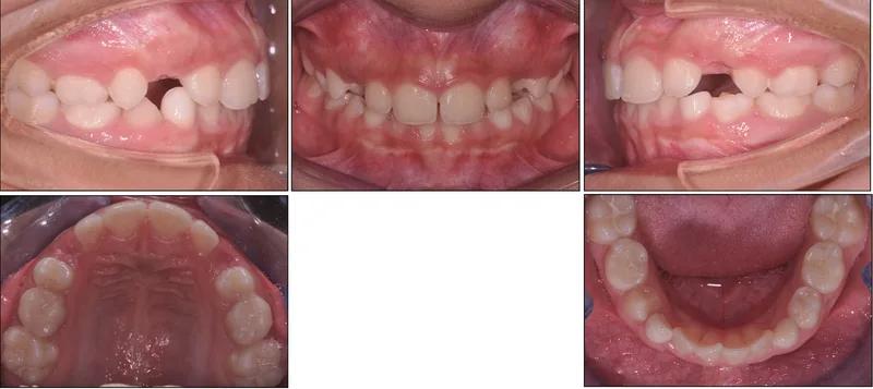 Palato stretto — dopo il trattamento con espansore