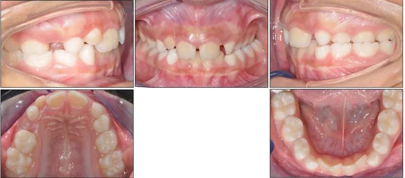 Palato stretto — prima del trattamento