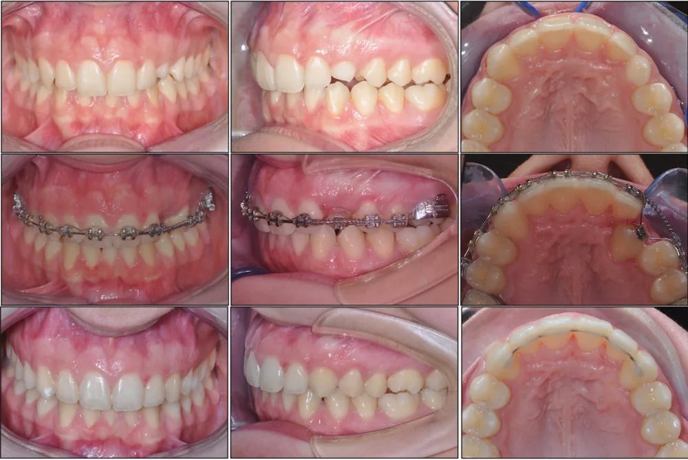 Denti inclusi — caso clinico 1