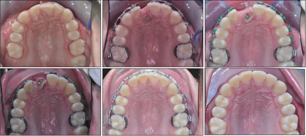 Denti inclusi — caso clinico 2