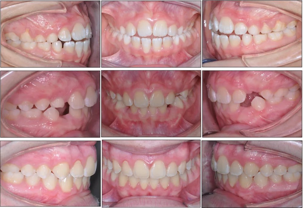 Morso aperto — caso clinico