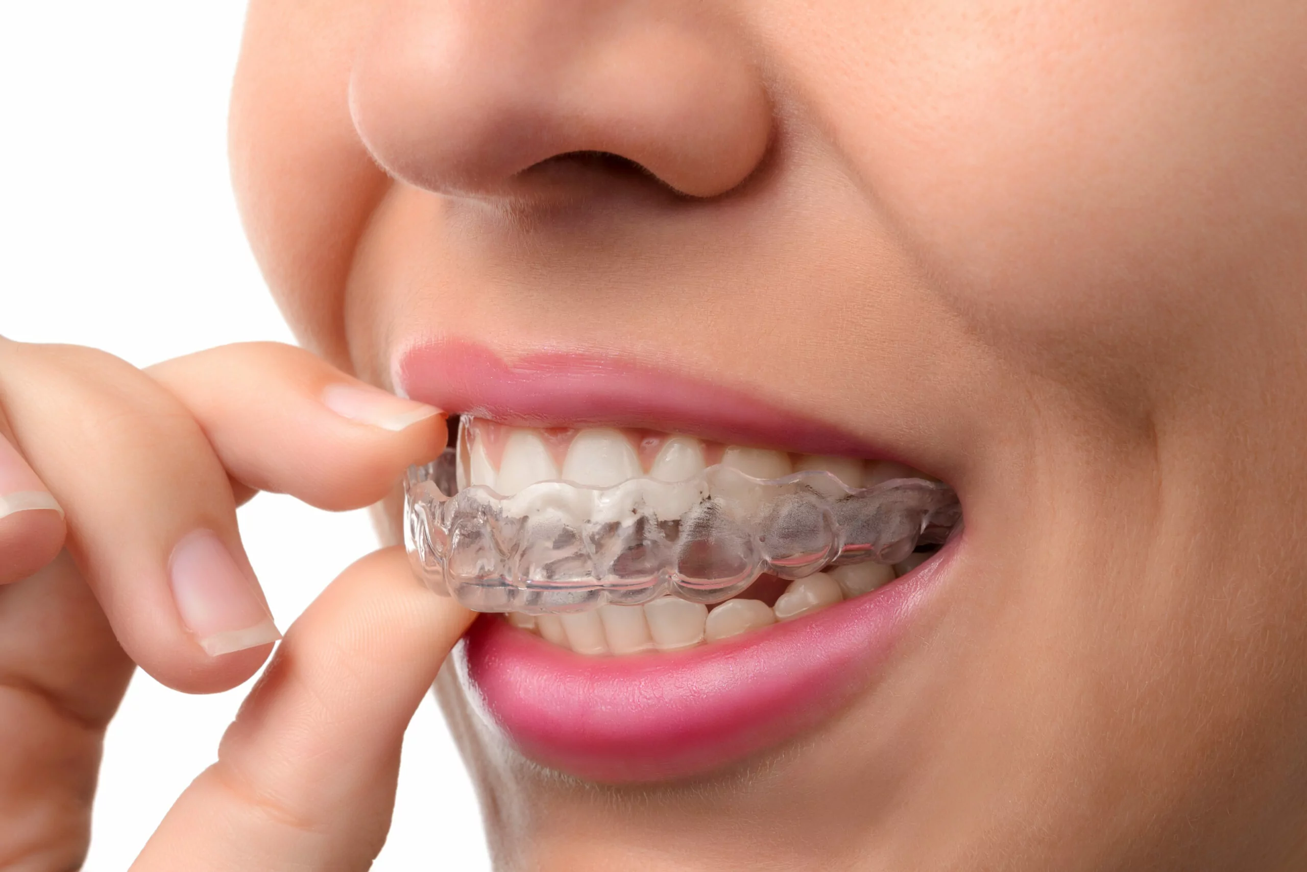 Retainer dopo l'apparecchio: a cosa serve, tipi e quanto va portato ...